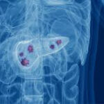 Dịch Slide | Điều trị bệnh ung thư ở người cao tuổi