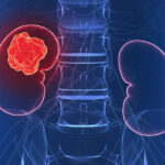 Một số phác đồ hoá chất trong ung thư nội mạc tử cung