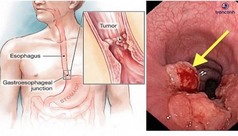 alt text: Nữ giới thường ít bị ung thư thực quản hơn nam giới