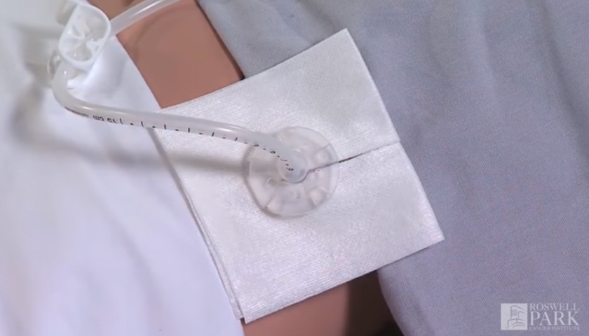 Cố định lỗ thông dạ dày