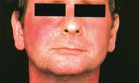 Đỏ da trong hội chứng Carcinoid