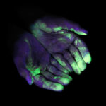 Điều trị sốt hạ bạch cầu theo kinh nghiệm