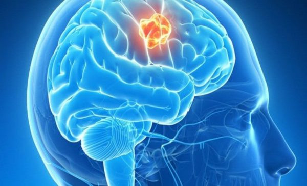 Hình ảnh minh họa về u não ác tính