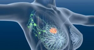 Ung thư vú bộ ba âm tính (Tripple negative Breast cancer) vẫn còn nhiều bí ẩn?