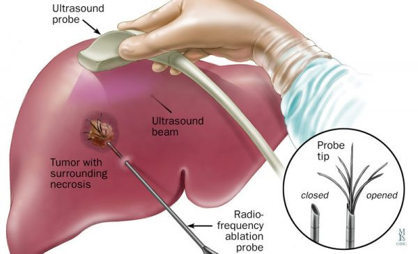 Hình ảnh ung thư gan