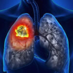 7 UNG THƯ nên sàng lọc cho Nam giới hiện nay bạn cần phải biết!