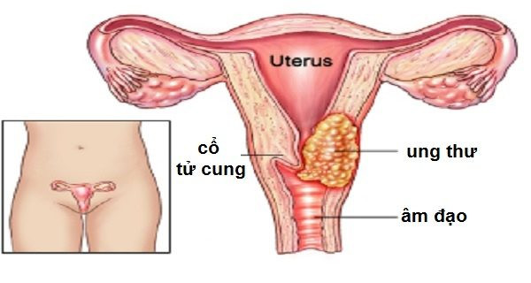 HPV là nguyên nhân gây ung thư cổ tử cung