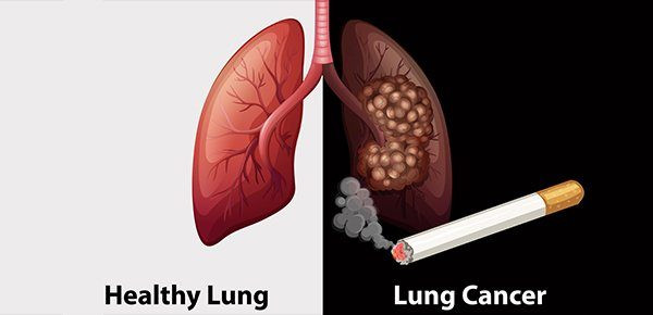 Hút thuốc lá là một trong các nguyên nhân hàng đầu gây ra COPD và ung thư phổi