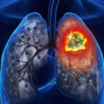 Thuốc lá – Nguyên nhân hàng đầu gây tử vong do bệnh ung thư