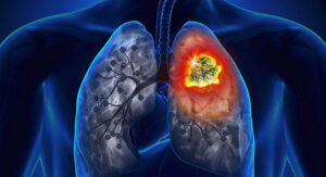 Thuốc lá – Nguyên nhân hàng đầu gây tử vong do bệnh ung thư