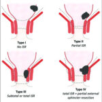 Phẫu thuật bảo tồn cơ thắt trong ung thư trực tràng thấp