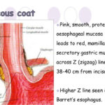 Tổng quan về ung thư ĐOẠN NỐI THỰC QUẢN – DẠ DÀY | Phần 1
