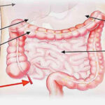 Những triệu chứng này cảnh báo bạn đang bị ung thư ruột non