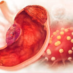 Những yếu tố nguy cơ của bệnh ung thư dạ dày bạn cần nắm được