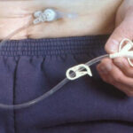 “Chung sống” với ống thông dạ dày – Những điều bạn cần biết