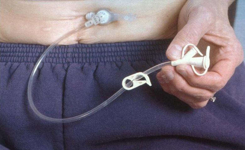 Ống thông dạ dày đặt qua thành bụng