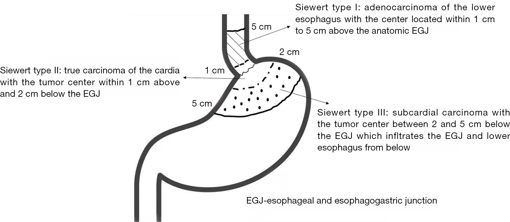 Phân loại ung thư biểu mô EGJ theo Siewert.