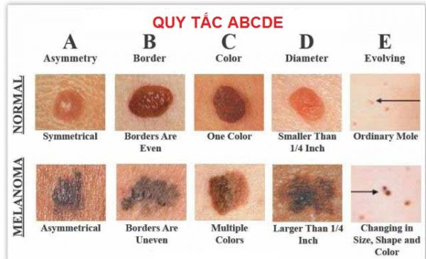Sàng lọc ung thư da sớm