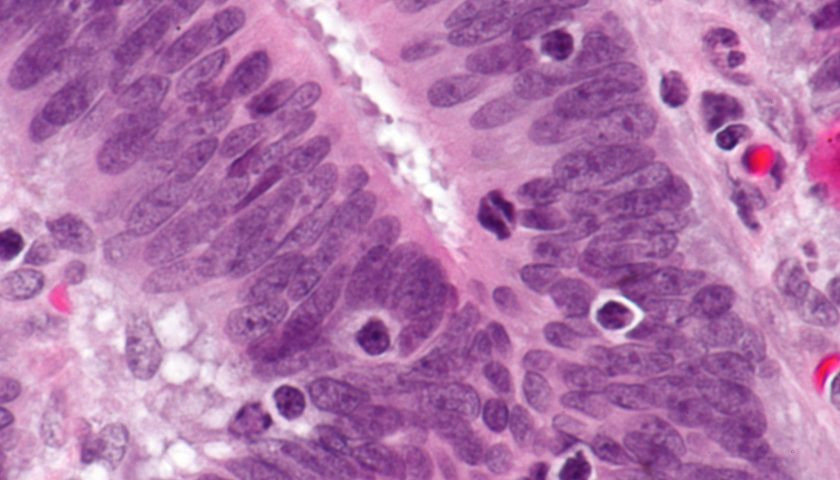 Thâm nhiễm bạch cầu lympho trong mô ung thư MSI-H