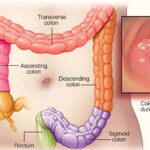 Bệnh ung thư đại trực tràng và phương pháp điều trị cho từng giai đoạn