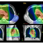 Tăng liều không mang lại hiệu quả tốt hơn trong xạ trị ung thư thực quản