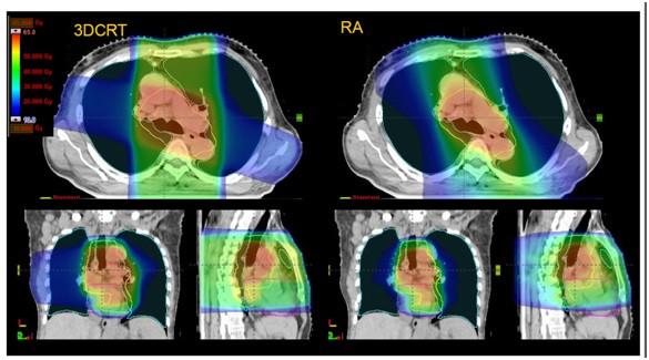 VMAT trong điều trị ung thư thực quản
